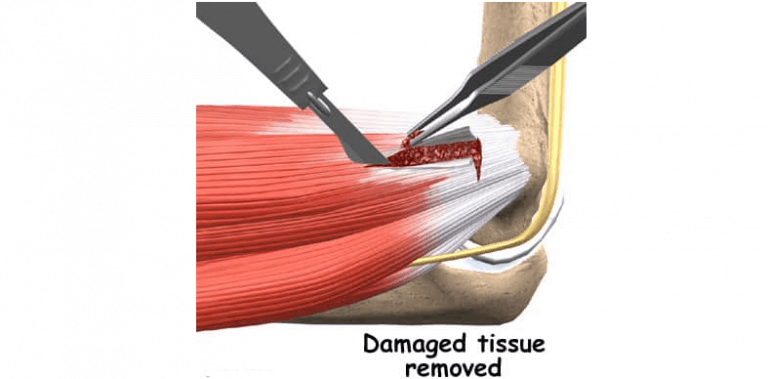 Medial Epicondylitis Symptoms, Causes and Treatment